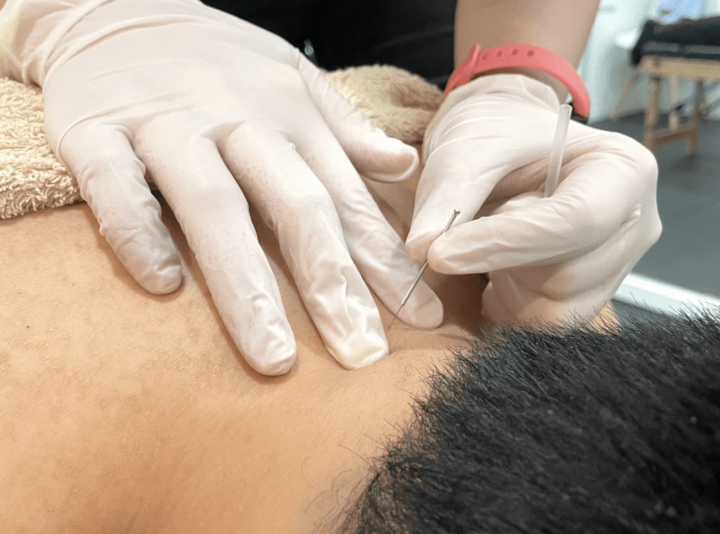 dry needling
