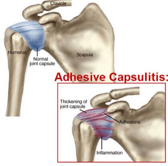 frozen shoulder symptoms
